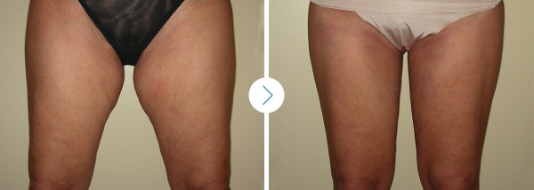 Short vertical scar medial thigh lift