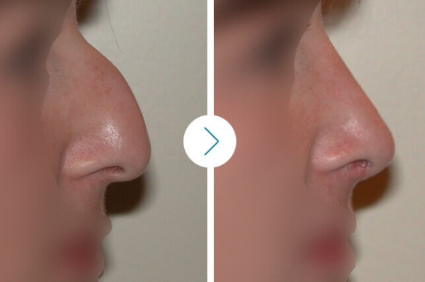 Rhinoplastie : corriger les défauts du nez